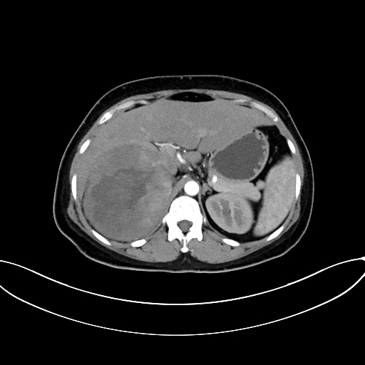 Adrenocortical carcinoma (Radiopaedia 87281-103569 Axial C+ arterial phase 27).jpg