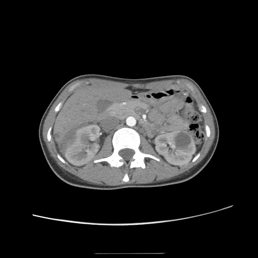 Adult polycystic kidney disease (Radiopaedia 48845-53876 Axial renal cortical phase 24).jpg