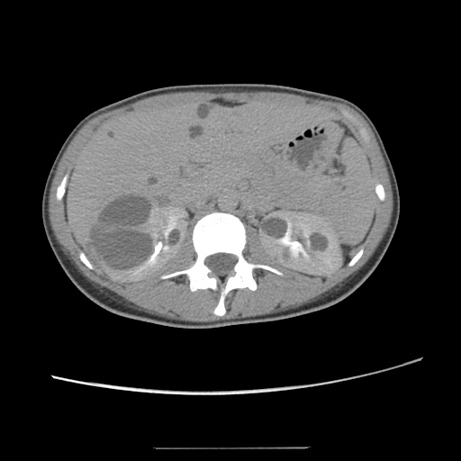 Adult polycystic kidney disease (Radiopaedia 48845-53876 Axial renal excretory phase 34).jpg