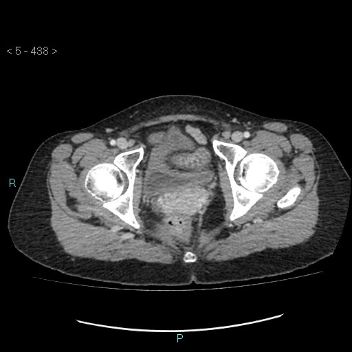 Adult transient intestinal intussusception (Radiopaedia 34853-36310 Axial C+ portal venous phase 116).jpg