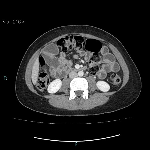 File:Adult transient intestinal intussusception (Radiopaedia 34853-36310 Axial C+ portal venous phase 41).jpg