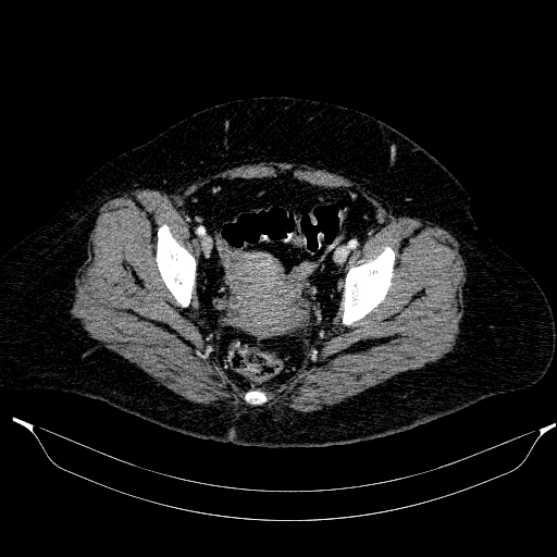 Afferent loop syndrome - secondary to incarcerated trocar site hernia (Radiopaedia 82959-97305 Axial C+ portal venous phase 209).jpg