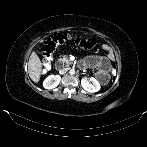 File:Afferent loop syndrome - secondary to incarcerated trocar site hernia (Radiopaedia 82959-97305 Axial C+ portal venous phase 90).jpg