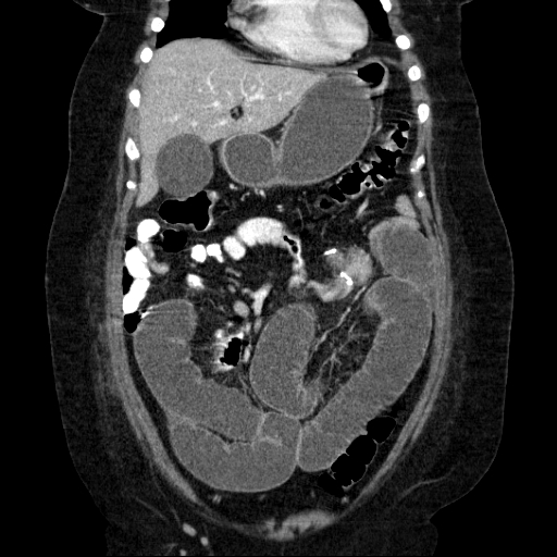 File:Afferent loop syndrome - secondary to incarcerated trocar site hernia (Radiopaedia 82959-97305 Coronal C+ portal venous phase 55).jpg