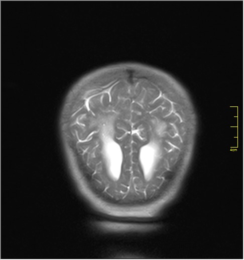 File:Agenesis of the corpus callosum (Radiopaedia 16190-16010 Sagittal T1 14).JPG