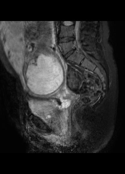 File:Aggressive angiomyxoma of the pelvis and perineum (Radiopaedia 59162-66479 Sagittal T2 fat sat 12).jpg