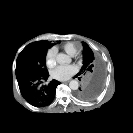 Aggressive lung cancer with cardiac metastases, pulmonary artery tumor thrombus, and Budd-Chiari (Radiopaedia 60320-67981 A 34).jpg
