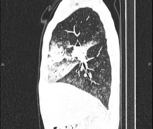 File:Air bronchogram in pneumonia (Radiopaedia 85719-101512 Sagittal lung window 34).jpg