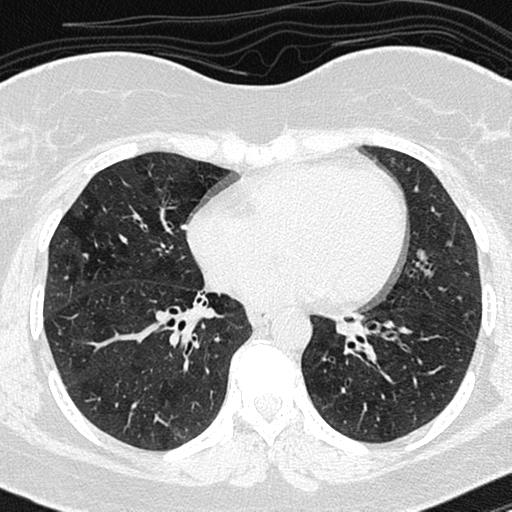 File:Air trapping in small airway disease (Radiopaedia 61685-69694 Axial lung window 103).jpg