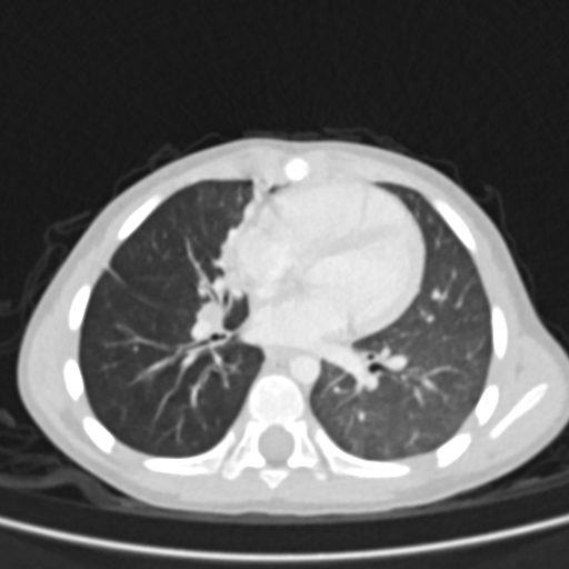 Airway foreign body (Radiopaedia 72128-82638 Axial lung window 50).jpg
