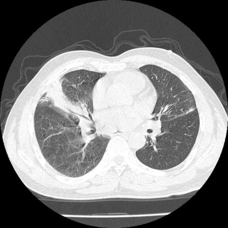 Airway foreign body in adult (Radiopaedia 85907-101779 Axial lung window 96).jpg