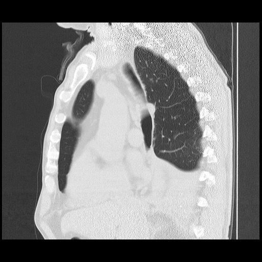 Allergic bronchopulmonary aspergillosis (ABPA) (Radiopaedia 60594-68313 Sagittal lung window 34).jpg