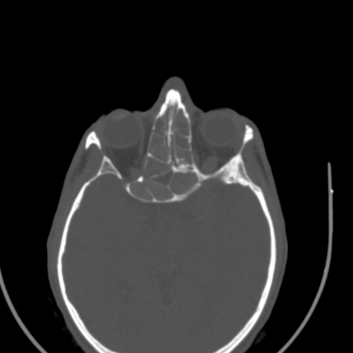 Allergic fungal sinusitis (Radiopaedia 88725-105456 Axial bone window 41).jpg