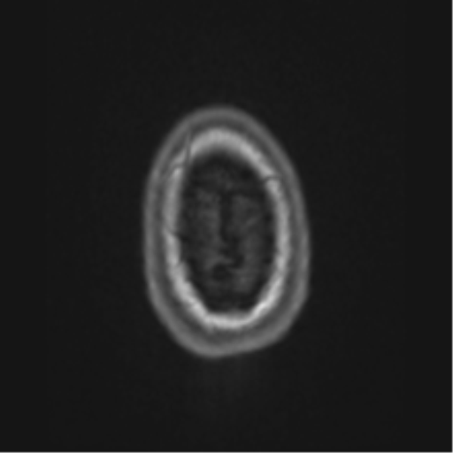 Alzheimer's disease- with apraxia (Radiopaedia 54763-61011 Axial T1 76).png