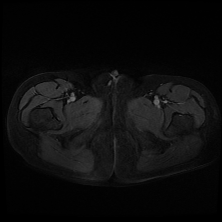 Ambiguous genitalia (Radiopaedia 69686-79643 Axial T1 C+ fat sat 56).jpg