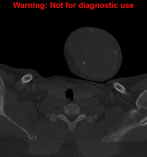 Ameloblastoma (Radiopaedia 33126-34164 Axial bone window 40).jpg