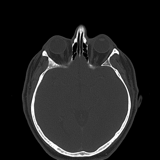 Ameloblastoma (Radiopaedia 38520-40623 Axial bone window 2).png