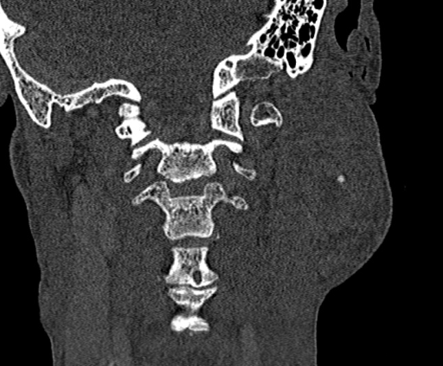 Ameloblastoma (Radiopaedia 51921-57766 Coronal bone window 235).jpg