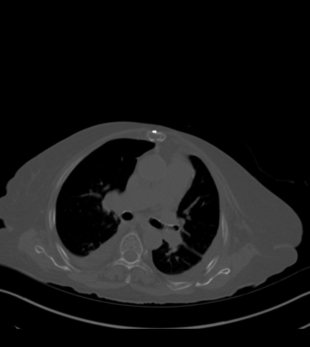 Amiodarone deposition in the liver (Radiopaedia 77587-89780 Axial bone window 36).jpg