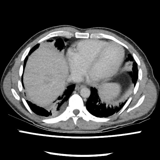 Amoebic liver abscesses (Radiopaedia 55536-62010 A 9).jpg