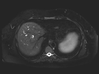 Ampullary adenocarcinoma (Radiopaedia 54765-61014 Axial T2 space-FS 10).jpg
