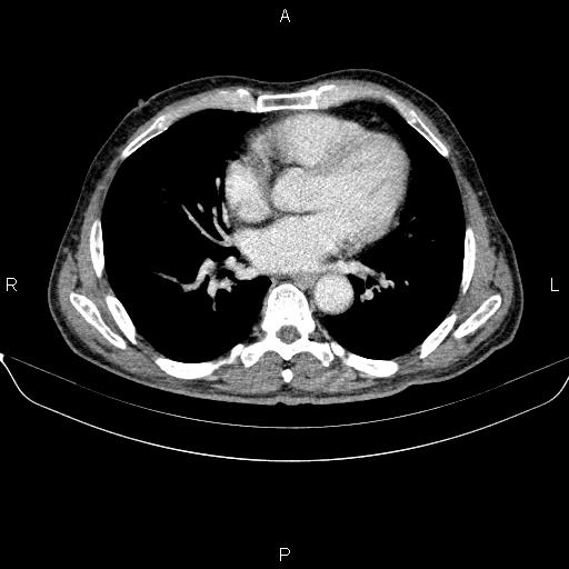 Ampullary adenocarcinoma (Radiopaedia 86093-102032 A 3).jpg