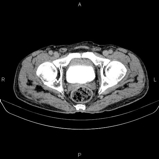 Ampullary adenocarcinoma (Radiopaedia 86093-102032 Axial C+ delayed 100).jpg