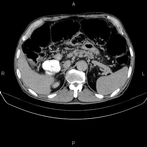 Ampullary adenocarcinoma (Radiopaedia 86093-102032 Axial C+ delayed 28).jpg