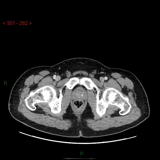 Ampullary carcinoma (Radiopaedia 56396-63056 C 102).jpg