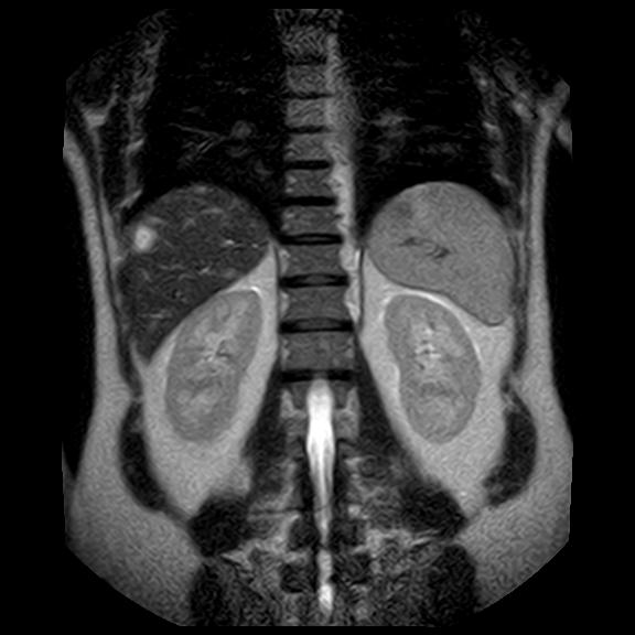 File:Ampullary tumor (Radiopaedia 27294-27479 Coronal T2 20).jpg