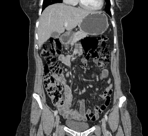 Ampullary tumor (Radiopaedia 60333-67998 B 25).jpg