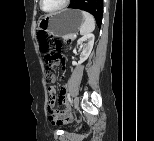 File:Ampullary tumor (Radiopaedia 60333-67998 C 42).jpg