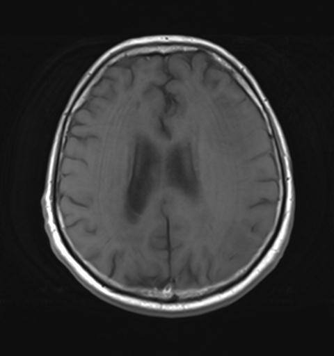 File:Amyloid angiopathy with inflammation (Radiopaedia 30360-31002 Axial T1 22).jpg