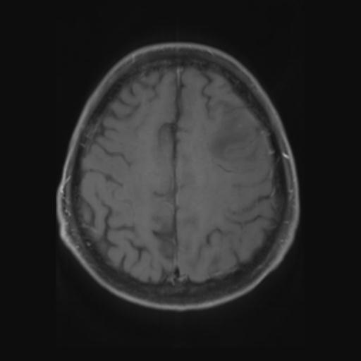File:Amyloid angiopathy with inflammation (Radiopaedia 30360-31002 Axial T1 C+ fat sat 25).jpg