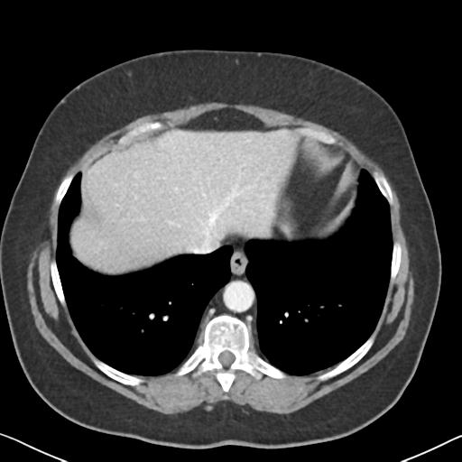 File:Anal adenocarcinoma - tumor regression grade 1 (Radiopaedia 31358-32103 Axial POST 9).jpg
