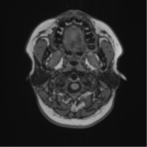 Anaplastic astroblastoma (Radiopaedia 55666-62194 Axial T1 2).png