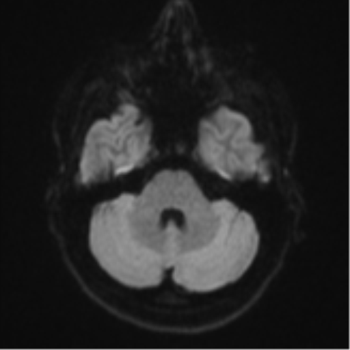File:Anaplastic astrocytoma (Radiopaedia 57768-64731 Axial DWI 35).png