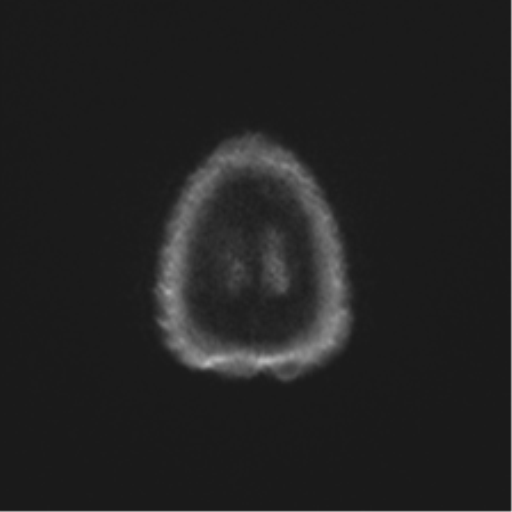 Anaplastic astrocytoma - thalamic glioma (Radiopaedia 59709-67115 Axial DWI 70).png