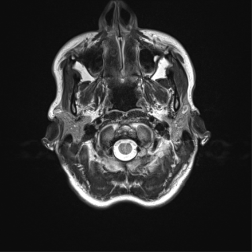 File:Anaplastic astrocytoma IDH mutant (Radiopaedia 50046-55341 Axial T2 3).png