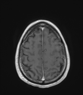 Anaplastic astrocytoma IDH wild-type (Radiopaedia 49984-55273 Axial T1 C+ 46).png