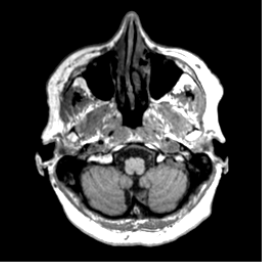Anaplastic astrocytoma IDH wild-type (pseudoprogression) (Radiopaedia 42209-45277 Axial T1 15).png