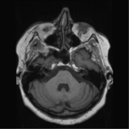 File:Anaplastic astrocytoma IDH wild-type (pseudoprogression) (Radiopaedia 42209-45278 Axial T1 48).png
