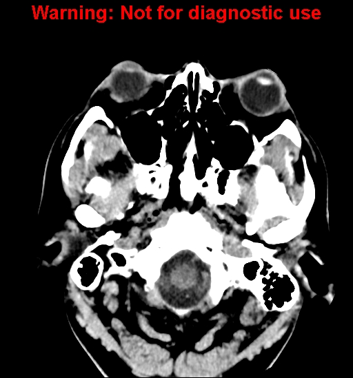 File:Anaplastic ganglioglioma (Radiopaedia 44921-48815 Axial non-contrast 2).jpg