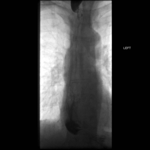 File:Anastomotic stricture post Ivor Lewis esophagectomy (Radiopaedia 47937-52715 B 41).png