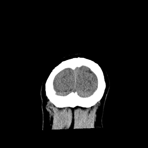 File:Aneursym related subarachnoid hemorrhage with hydrocephalus (Radiopaedia 45105-49083 Coronal non-contrast 63).jpg