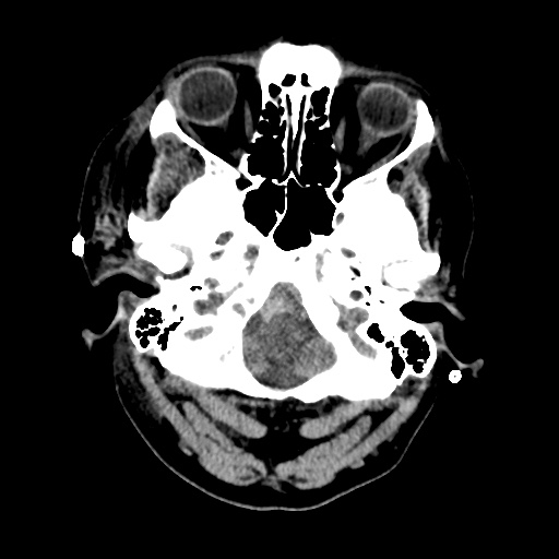 Aneursym related subarachnoid hemorrhage with hydrocephalus (Radiopaedia 45105-49085 Axial non-contrast 5).jpg