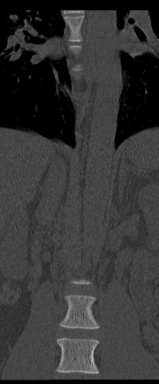 Aneurysmal bone cyst T11 (Radiopaedia 29294-29721 Coronal bone window 12).jpg