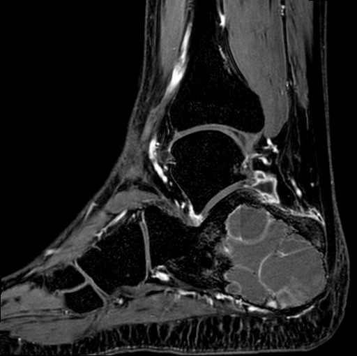 File:Aneurysmal bone cyst of the calcaneus (Radiopaedia 60669-68420 F 15).jpg