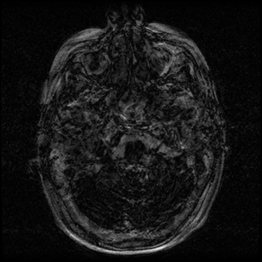 Angioinvasive aspergillosis in the pituitary fossa (Radiopaedia 39676-42010 Ax 3D FIESTA VOLUME 3).png