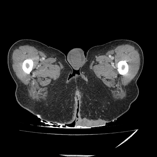 Anorectal carcinoma (Radiopaedia 44413-48064 A 69).jpg